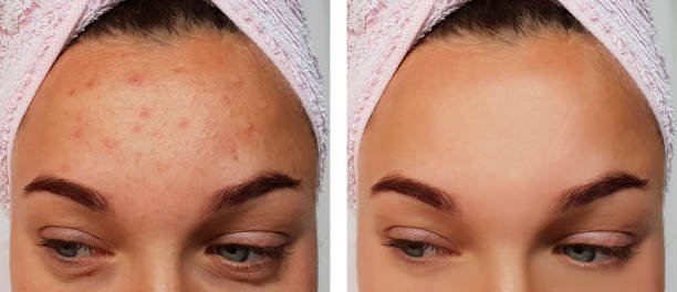 girl pimples on the forehead before and after the procedure